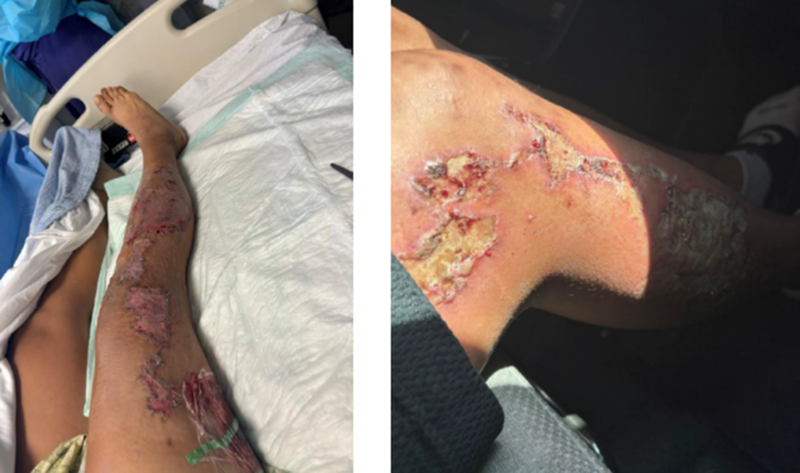 Image: A person's leg is blistered and raw, lying against hospital bedding.
