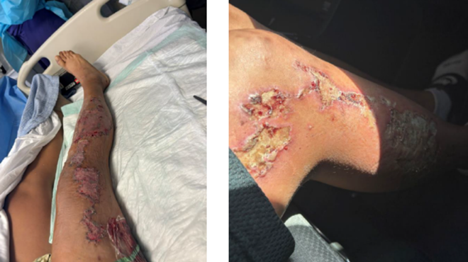 A person's leg is blistered and raw, lying against hospital bedding.